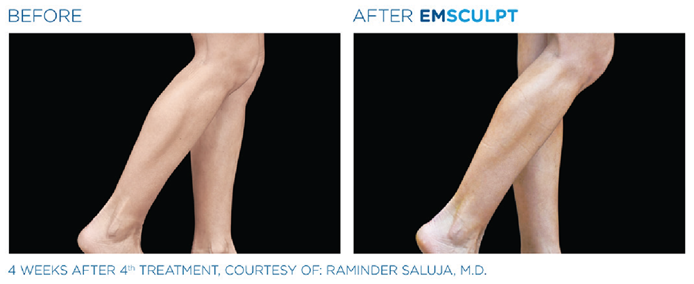 emsculpt legs