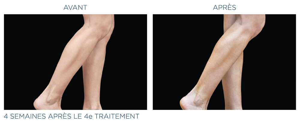 emsculpt mollets