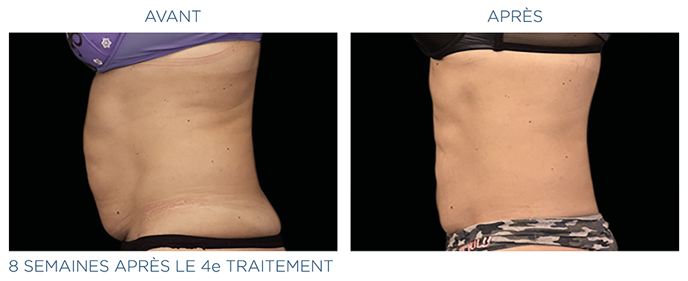 emsculpt abdomen femme
