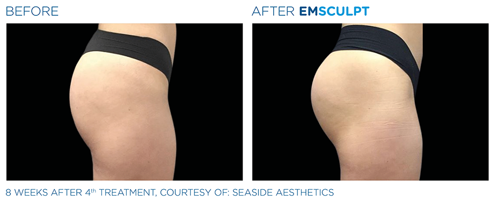 emsculpt female buttock