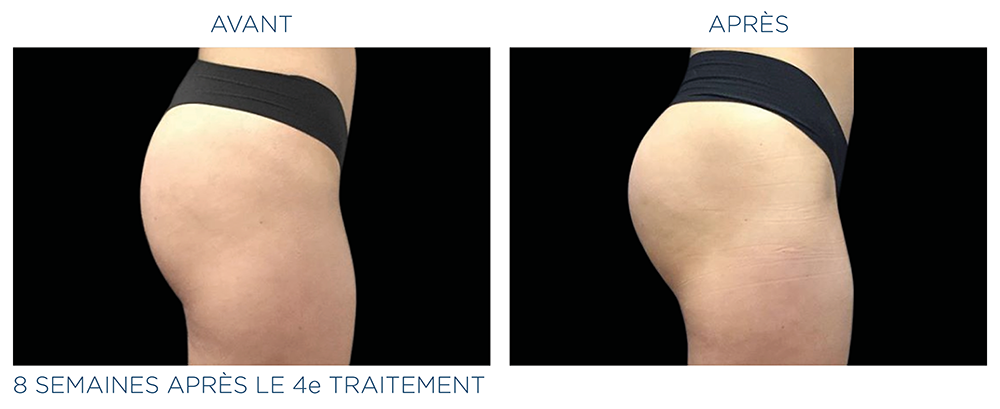 emsculpt fesses femme